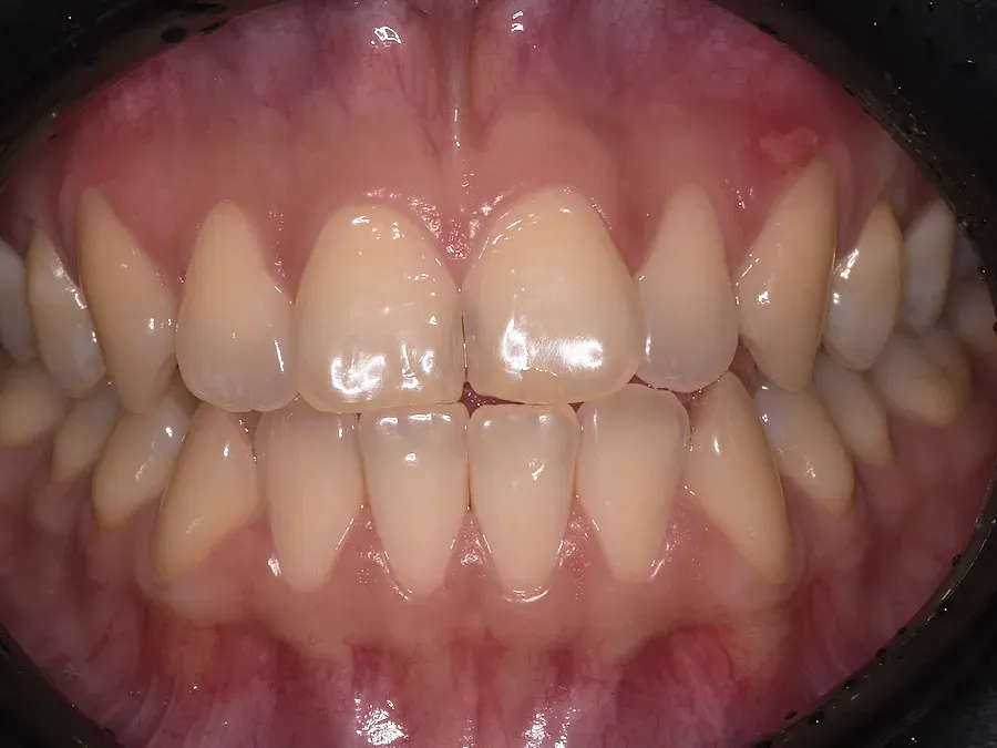 Dientes antes del blanqueamiento
