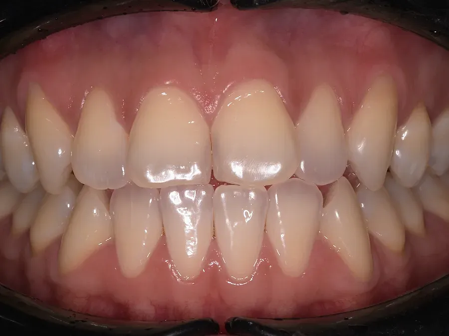 Dientes después del blanqueamiento