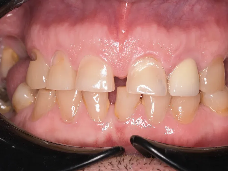 Dientes superiores con espacios antes de las carillas