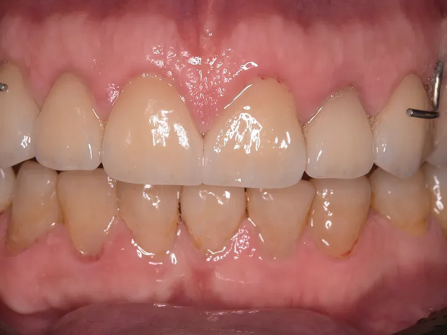 Dientes superiores con carillas terminadas