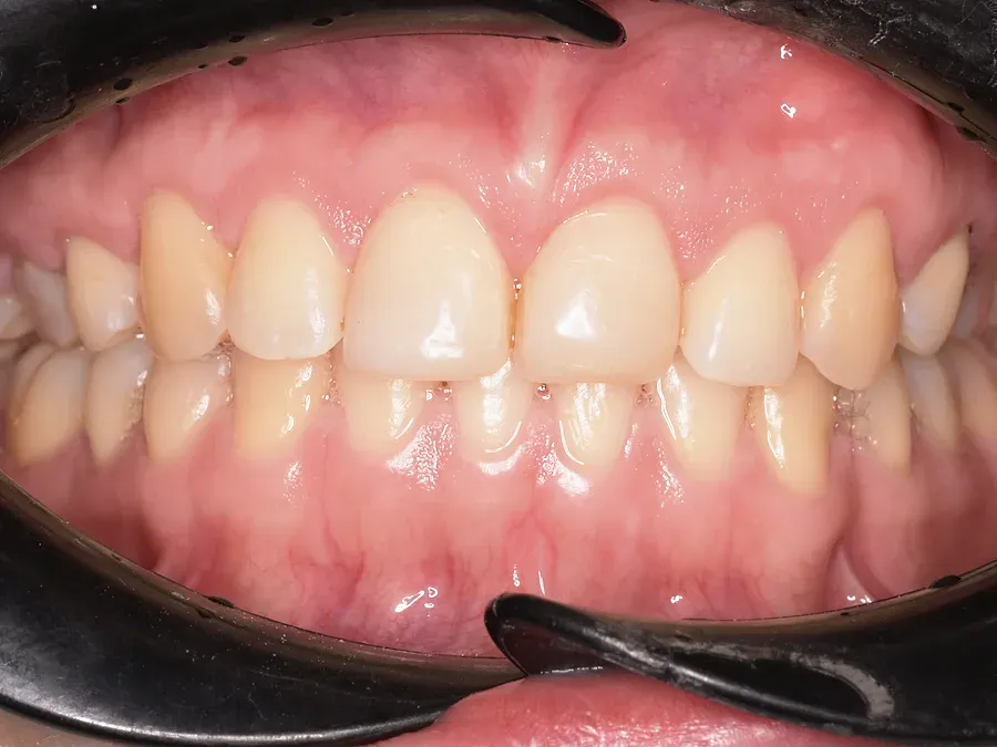 Dientes antes del diseño de sonrisa