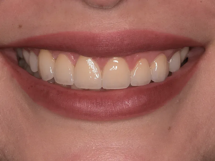 Sonrisa después del diseño de sonrisa