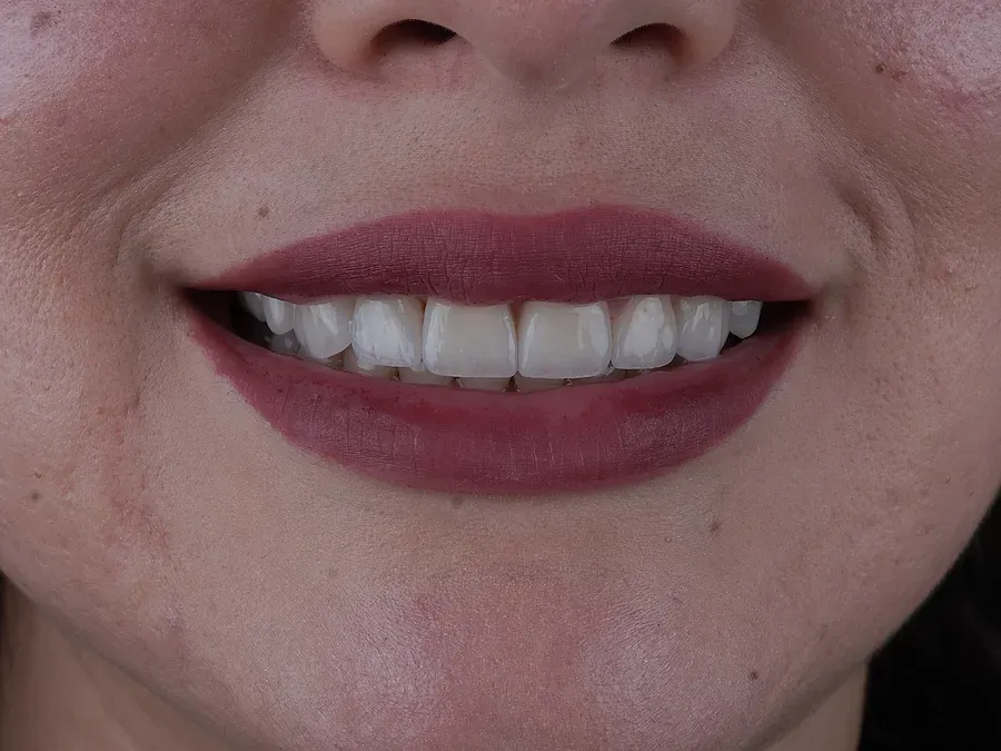 Sonrisa terminada de una paciente
