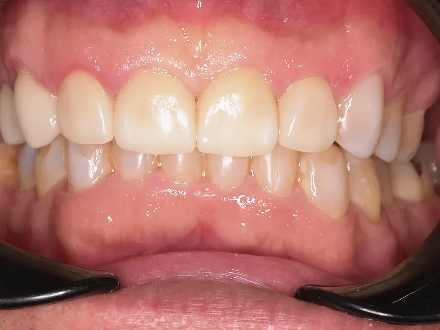 Dientes superiores después del tratamiento estético