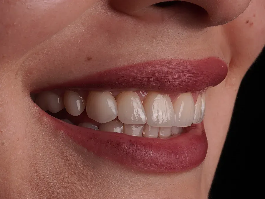 Sonrisa terminada vista de perfil
