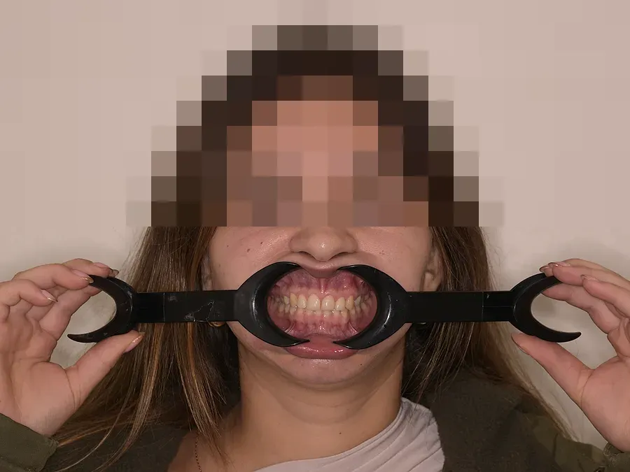 Paciente en sus fotos iniciales con separador bucal y los ojos pixelados